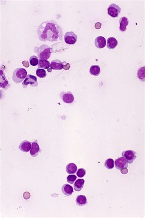 Lymphocytes Clinical Laboratory Science