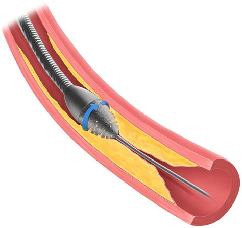 Therapy for severely calcified coronary vessels – USZ