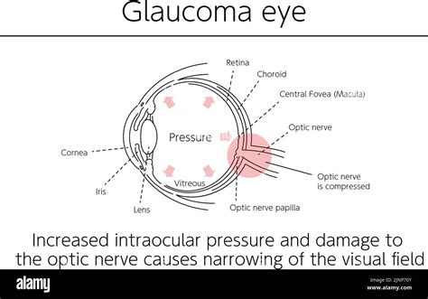 Ilustración Glaucoma Del Ojo Ilustraciones Médicas Imagen Vector De