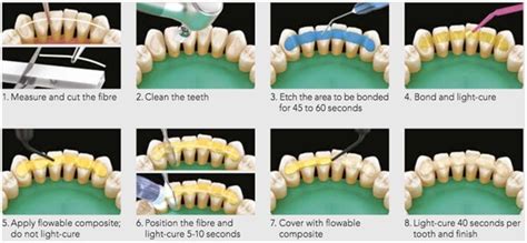 Periodontal Splinting, Discover the Techniques & Cost