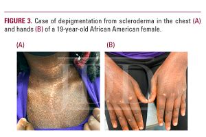 Atypical Dyschromia In Skin Of Color Next Steps In Dermatology