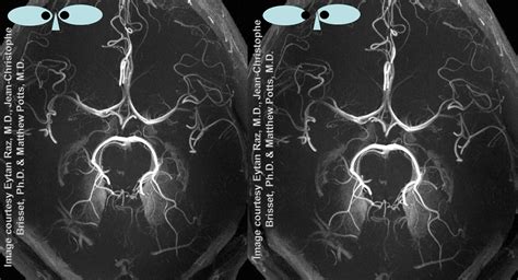 Anterior Choroidal Artery | neuroangio.org