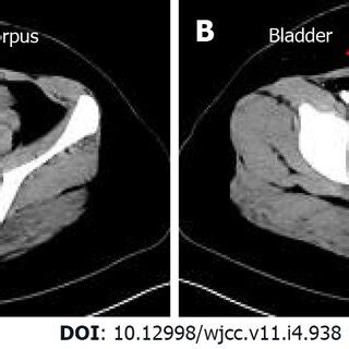 Computerized tomography imaging. A: Uterine body; B: Lower uterine ...