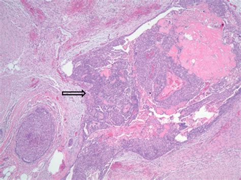 An Unusual Case Of Fibromatosis Of The Breast With Numerous Intraductal Papillomas Acs