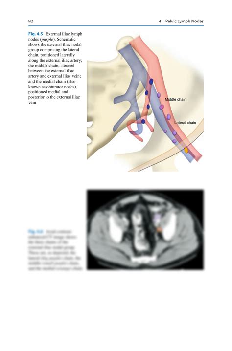 SOLUTION: Pelvic lymph nodes - Studypool