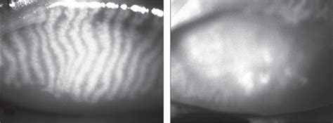 1 Meibography. Imaging of the meibomian gland is used to diagnose ...