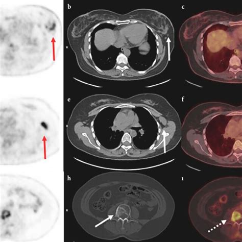 47 Years Old Woman With Luminal B Type Invasive Mucinous Breast Cancer