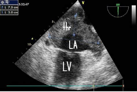 Transesophageal Echocardiography Revealed A Giant Atrial Thrombus