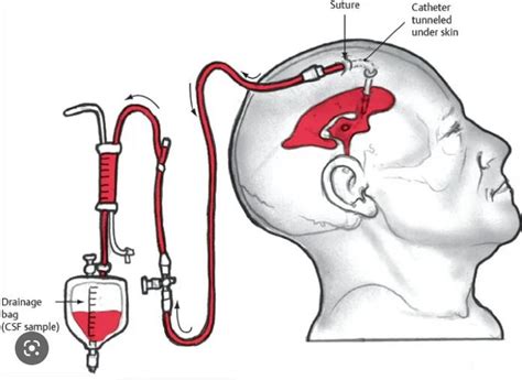 What Are The Benefits Of External Ventricular Drains