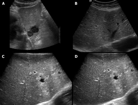 Ultrasound Images Showing Variable Echogenicity Of Liver Metastases A Download Scientific