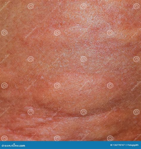 Allergy Skin Back And Sides Allergic Reactions On The Skin In T Stock