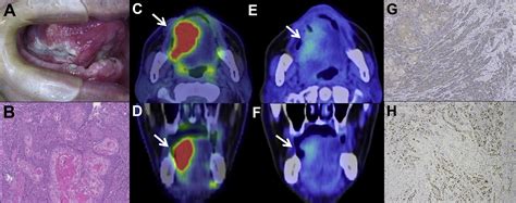 18F Fluoromisonidazole Positron Emission Tomography FMISO PET May