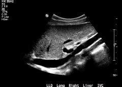 Liver Lobes Ultrasound