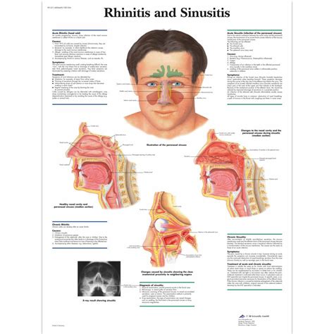 Rhinitis and Sinusitis Chart - SEM Trainers