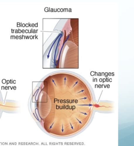 Glaucoma Flashcards Quizlet