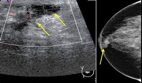 Non Puerperal Mastitis Radiology Cases