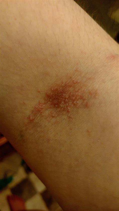 a couple years back when I had eczema in my elbow creases. anyone's look similar? : r/eczema