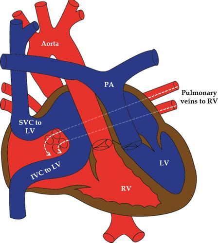 Multimodality Imaging Of Transposition Of The Great Arteries