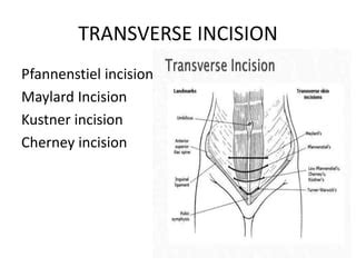 Abdominal Incisions Ppt