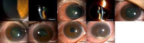 Clinical Presentation Of Acute Uveitis At The Initial Visit Slit Lamp