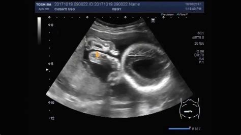 Neonatal Head Ultrasound Hydrocephalus