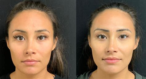 Before After BOTOX Fillers Chemical Peels Natural Injector