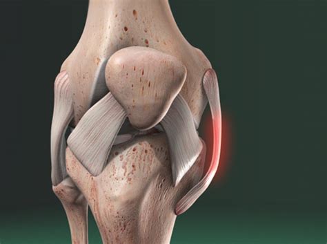 Video Medial Collateral Ligament MCL Injury HealthClips Online