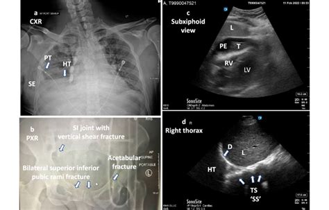 a Chest X-ray AP view. Right sided hemothorax, right lateral ...