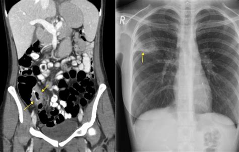 Tb Terminal Ileitis Radiology At St Vincents University Hospital