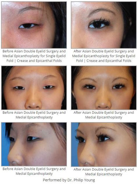 Before After Asian Double Eyelid Surgery And Medial Epicanthoplasty