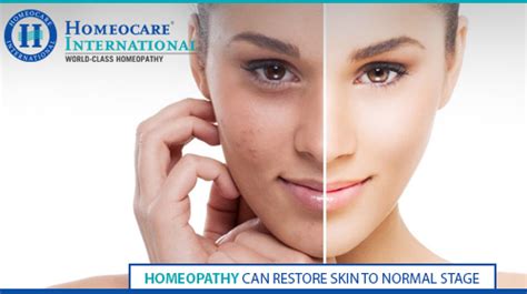 Homeopathy Treatment Helps In Reducing Skin Disorders