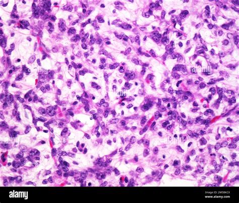 Liposarcoma Light Micrograph Liposarcoma Is One Of The Most Common