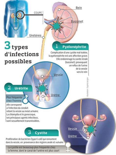 Quoi Sont Dues Les Infections Urinaires Et Comment Les Viter