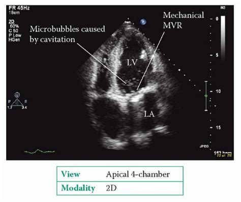 Heart Valve Repair And Replacement Thoracic Key