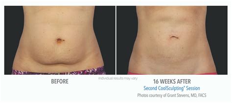 Busting Top CoolSculpting Myths Vein Laser Institute Vein And Laser