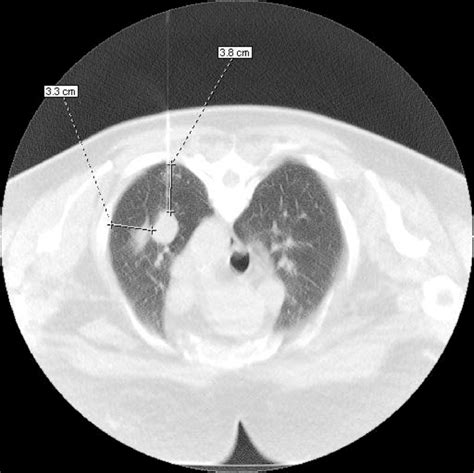 Figure 1 From Ct Guided Transthoracic Needle Biopsy Induced