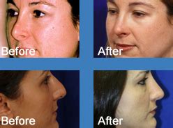 Los Angeles Revision Rhinoplasty Beverly Hills Revision Rhinoplasty