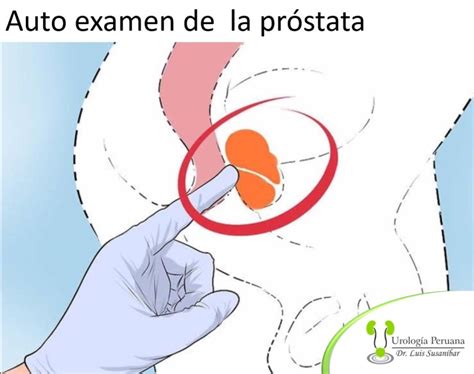 Hágase Usted Mismo Un Examen De Próstata Urología Peruana Dr