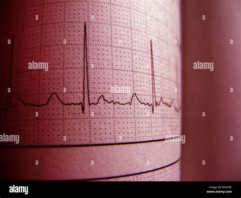 Sinus Heart Rhythm On Electrocardiogram Record Paper Showing Normal P