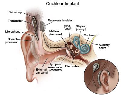 Cochlear Implants What To Expect During Surgery