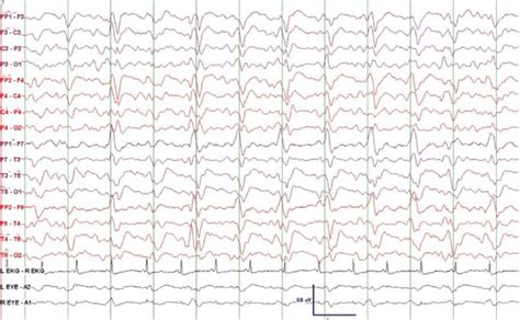 Eeg Epoch Of Patient Showing Generalized Periodic Discharges Gpds