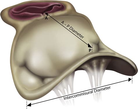 Automated Quantification Of Mitral Valve Geometry On Multi Slice