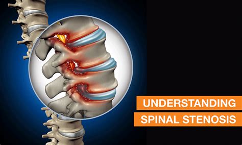 Spinal Stenosis Symptoms & Non-Surgical Treatment Options | QI Spine