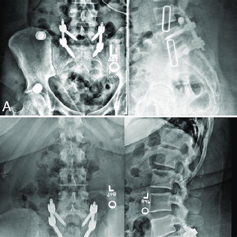 A Upright Postoperative Anteroposterior Left And Lateral Right