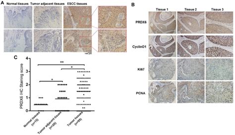 Upregulation Of Prdx6 In Escc Samples A Representative Ihc Staining