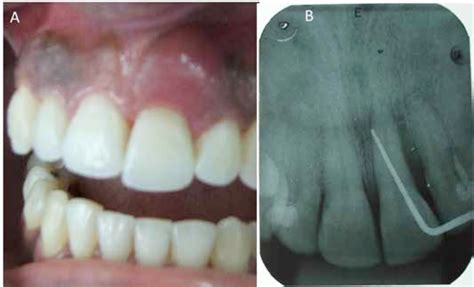 Figure From The Treatment Of Acute Periodontal Abscess And Secondary