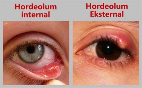 natural ways  cure hordeolum kesterluc