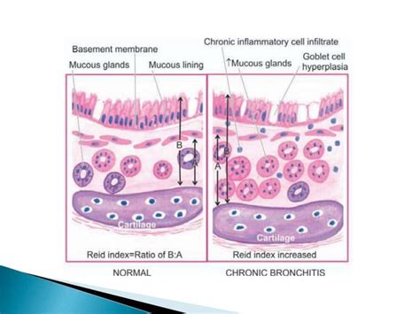 Chronic Bronchitis.pptx