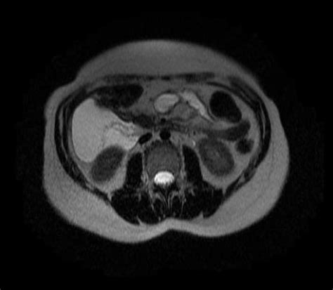 Mesenteric cyst - wikidoc