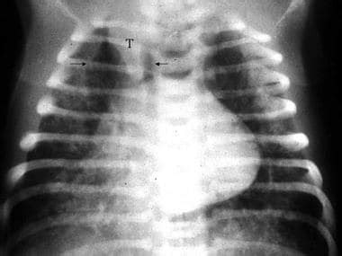 Meconium Aspiration Chest X Ray